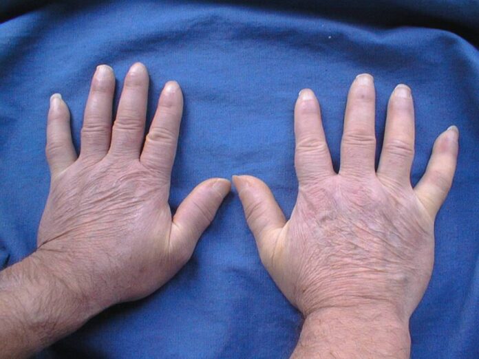 SCLERODERMIA