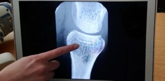 Osteoporosi, due giorni di studi a Barletta il 10 ed 11 ottobre